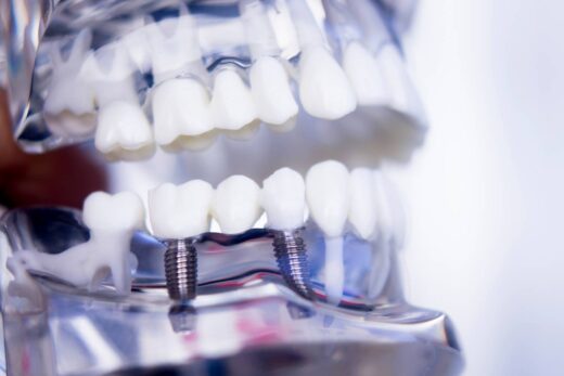 Implanty dentystyczne – powiew przyszłości