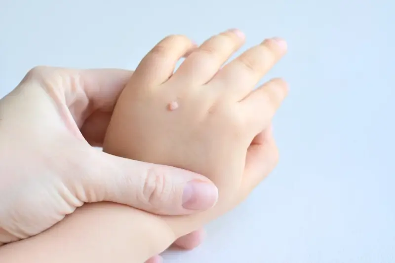 Ile kosztuje usunięcie kurzajki u dermatologa?